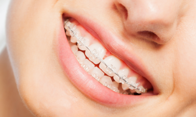 Higiena zębów z aparatem ortodontycznym